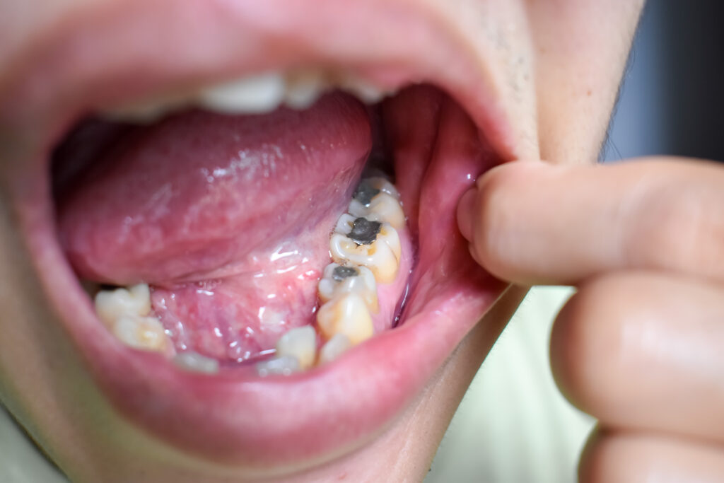 metal filling in patient's mouth